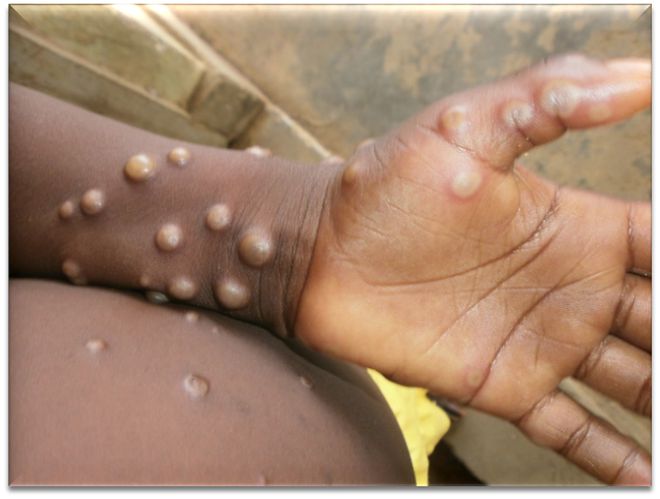 天博猴痘八成病例指向男男人群？它与艾滋病有何关系？(图7)