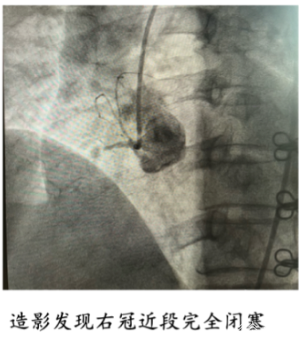 天博官方网站“牙痛”竟查出心脏病一台“天花板级”手术挽救性命(图2)