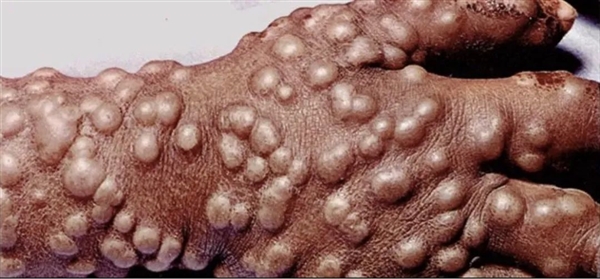 天博官方网站肆虐人间数千年的天花 是人类唯一消灭的传染病(图3)